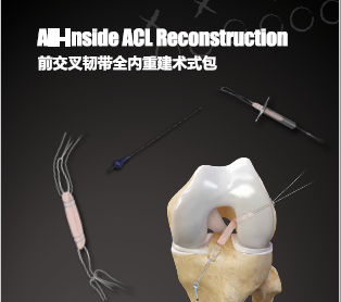 膝关节前交叉韧带全内重建术式包
