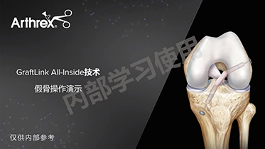 假骨操作-GraftLink ACL全内重建 