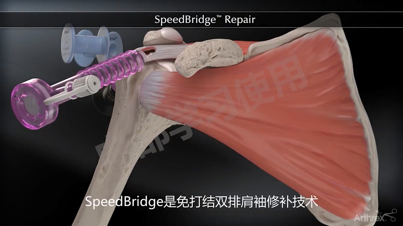 动画演示-SpeedBridge 修复技术