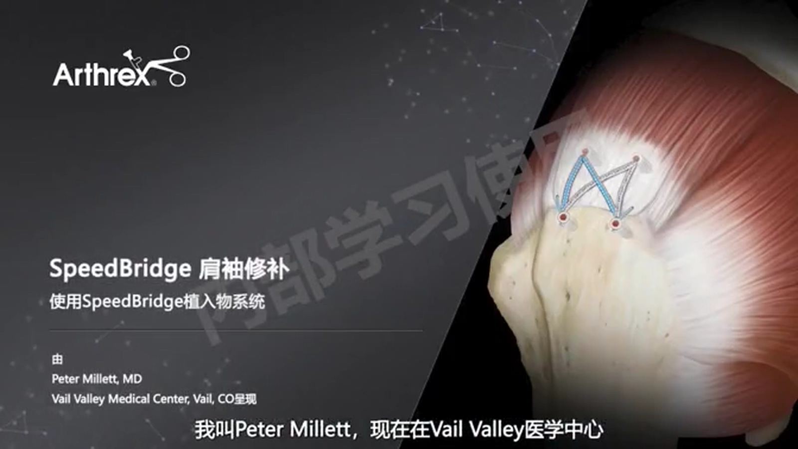 手术演示-SpeedBridge修复技术
