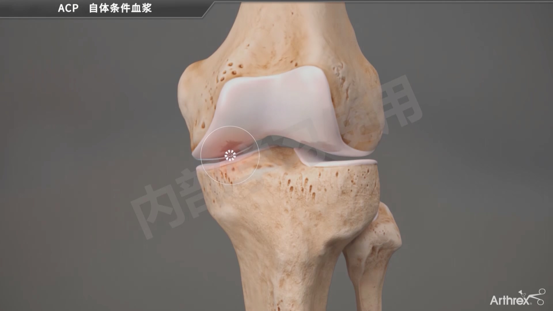 动画演示-ACP与OA病理机制