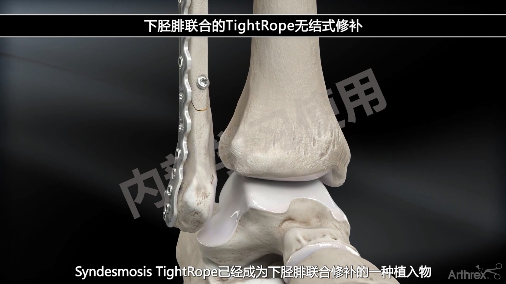 动画演示-下胫腓联合的TightRope无结式修补