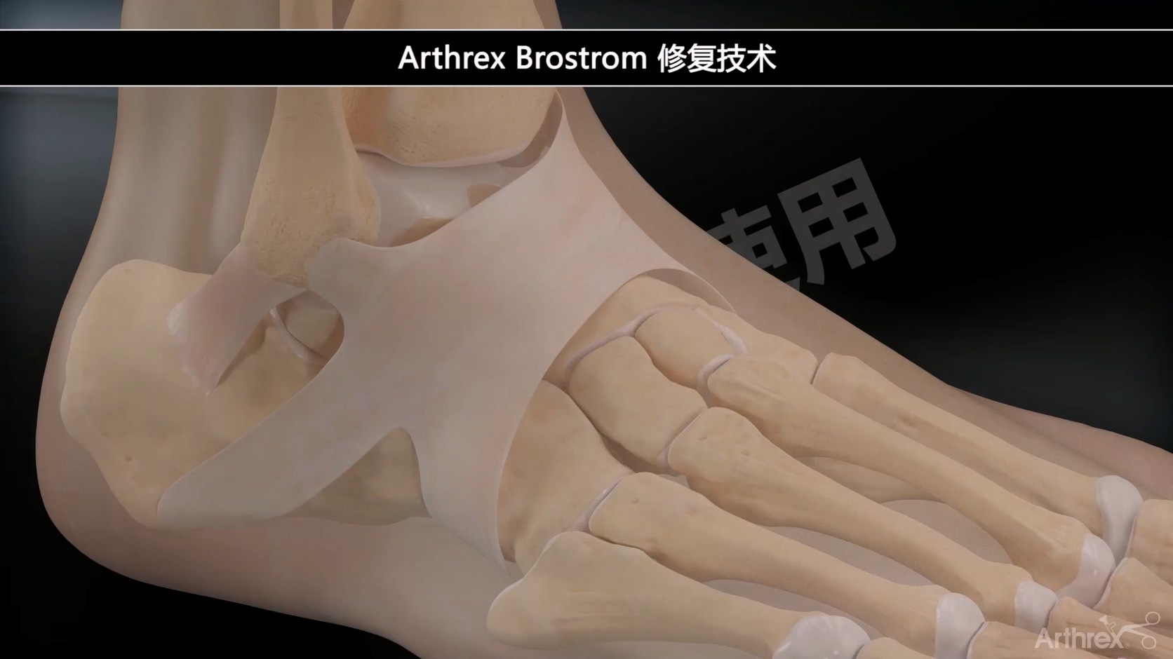 动画演示-外踝不稳Brostrom修复术式