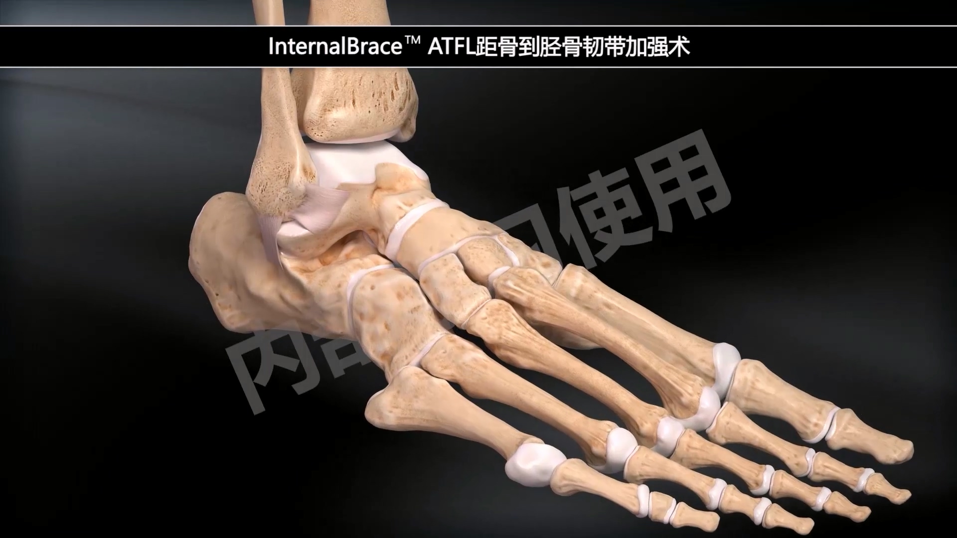 动画演示-InternalBrace 距骨到胫骨韧带加强术