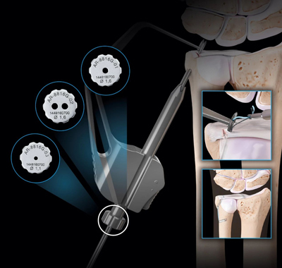 【新品快讯】Arthrex新一代TFCC手腕导向器已获NMPA批准