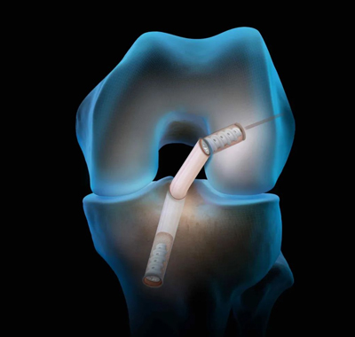 【新品快讯】FastThread™ BioComposite Interference Screw全新一代可吸收界面螺钉隆重上市